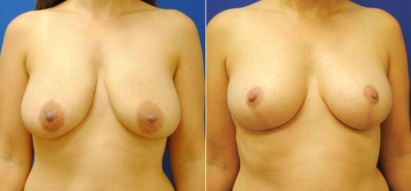 Before & After Breast Reduction Photos