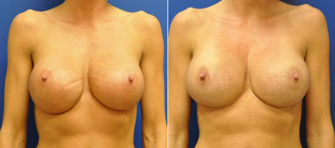 Before & After Breast Revision Photos