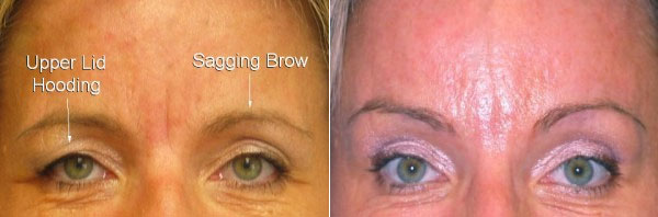 Before &Amp; After Brow Lift Photos