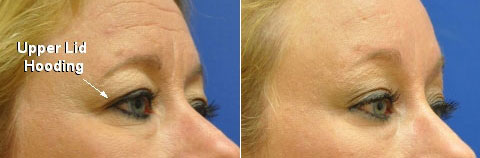 Before &Amp; After Brow Lift Photos
