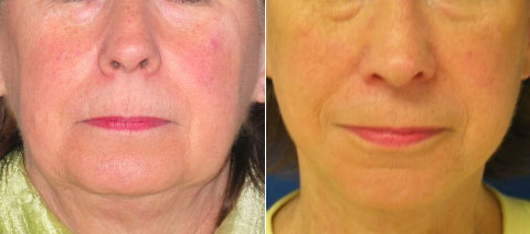 Before & After Facelift Photos