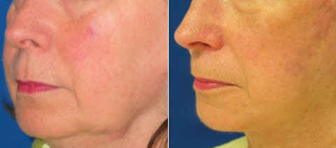 Before & After Facelift Photos