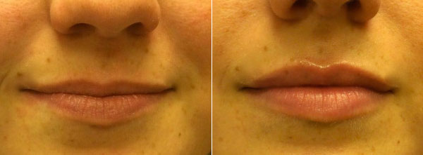 Before & After Juvederm Photos