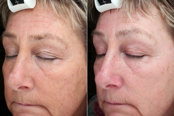 Before & After Laser Treatments Photos