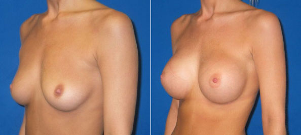 Before & After Silicone Breast Augmentation Photos