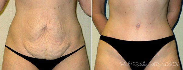 Before & After Tummy Tuck Photos
