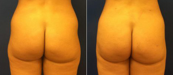 Before & After Liposuction Photos