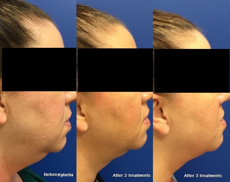 Kybella before and after