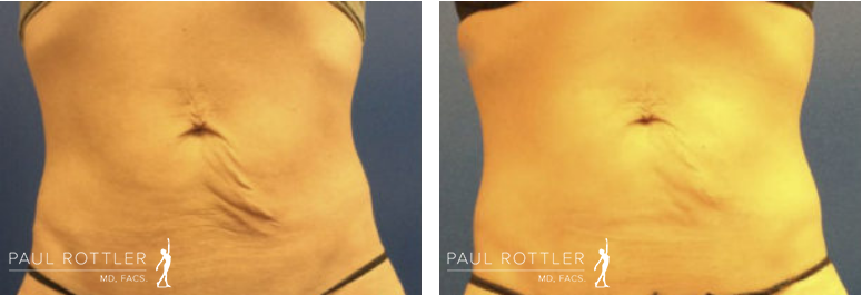 Before & After Exilis Ultra 360 Photos