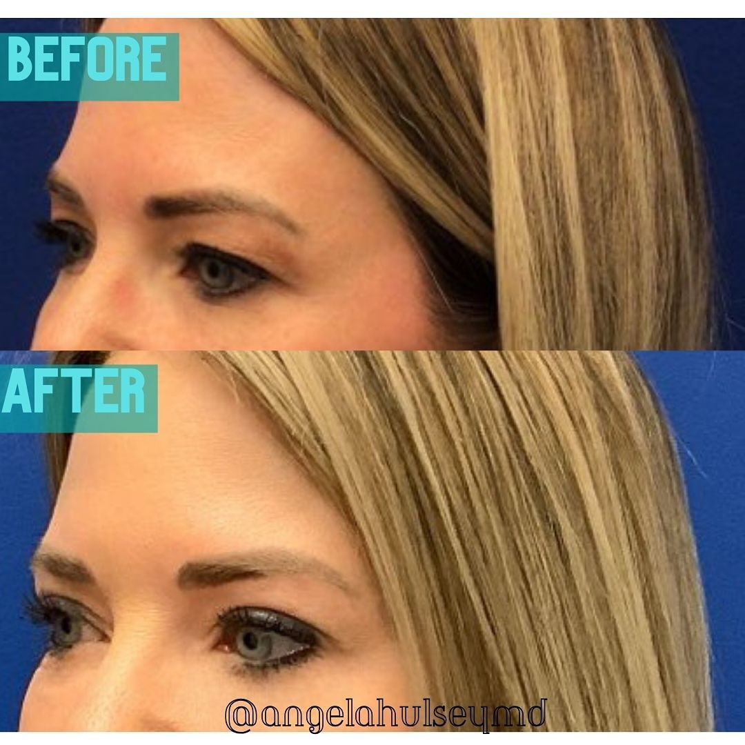 Before & After Blepharoplasty Photos
