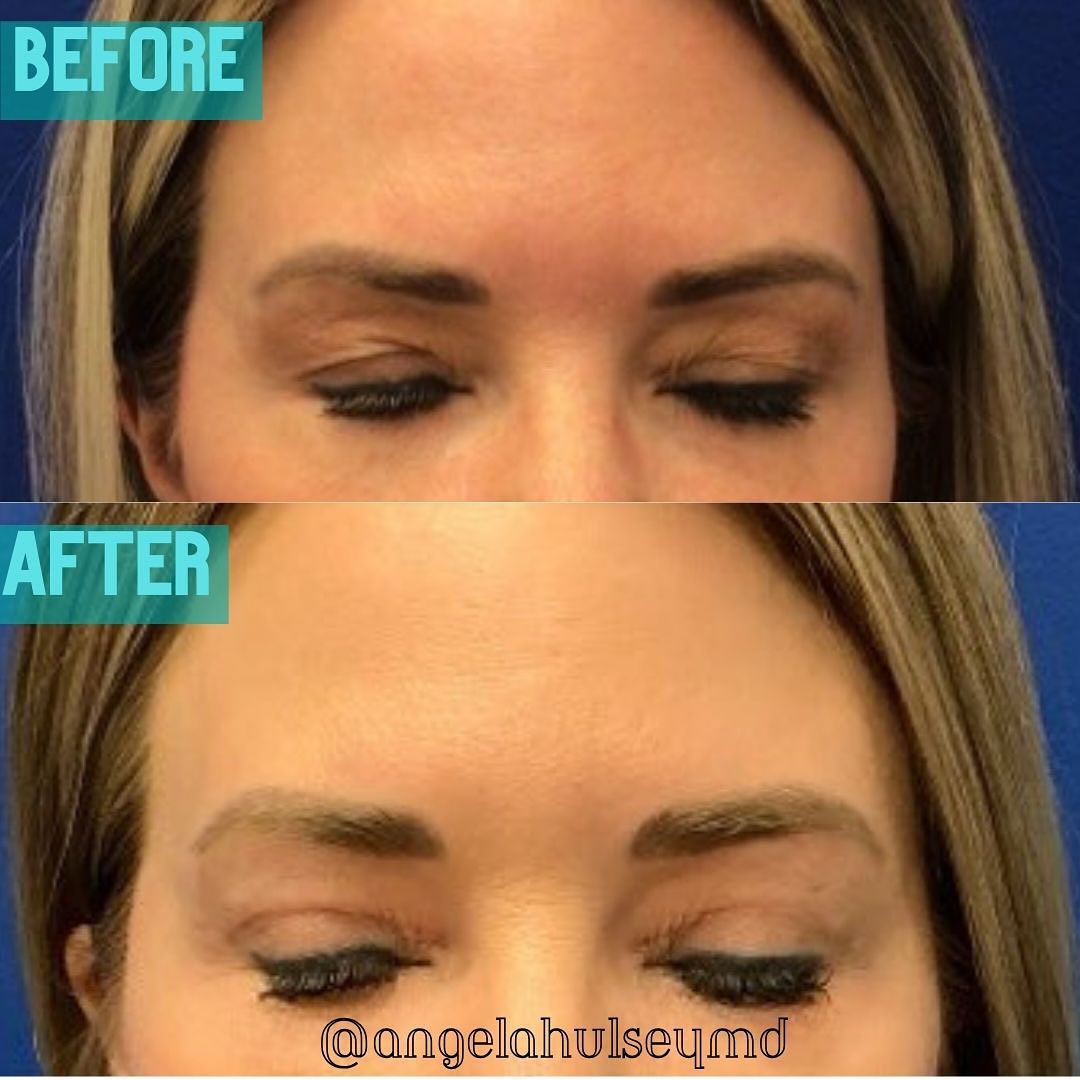 Before & After Blepharoplasty Photos