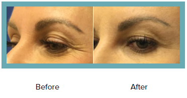 Botox® For Crow’s Feet In St. Louis 2 Botox® For Crow’s Feet Before And After